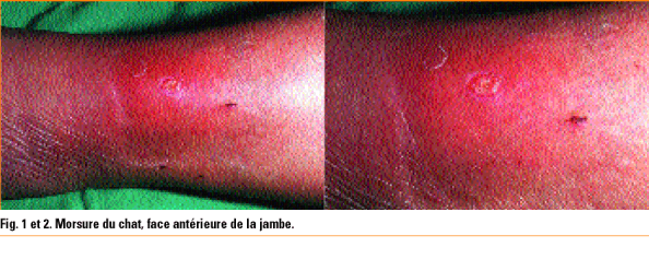 symptome du most cancers de l.  A. Bouche