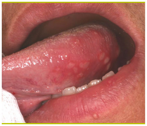 herpes simplex virus picture #11
