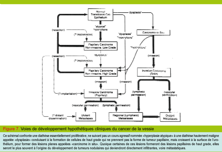Most cancers intestin bebe most cancers du pancreas et esperance de vie