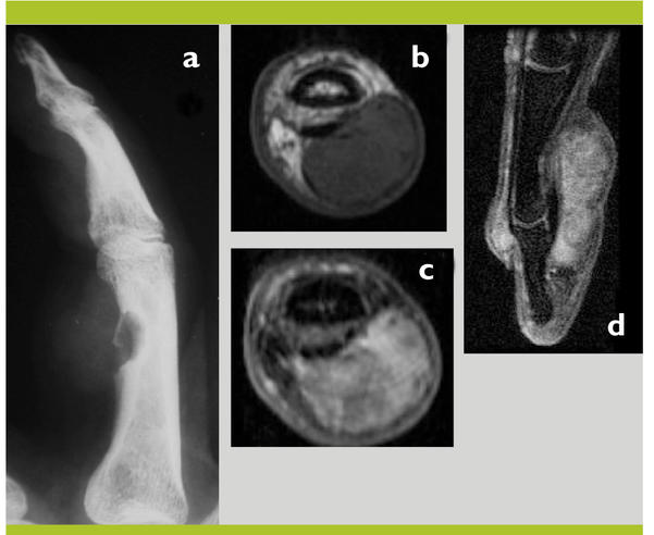 Imagerie des tumeurs et des lésions d'apparence tumorale de la main