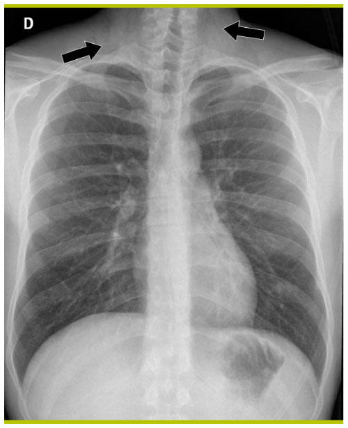 pneumothorax radiographie pulmonaire