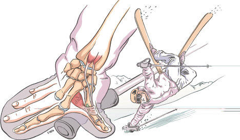 Entorse de l’articulation métacarpo-phalangienne du pouce avec lésion du ligament collatéral ulnaire