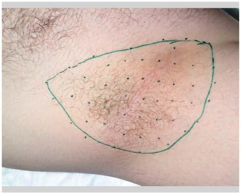 hyperhidrose toxine botulique viermele de noapte este preliminar