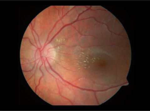 Névrite du nerf optique : diagnostic, traitement et implications ...