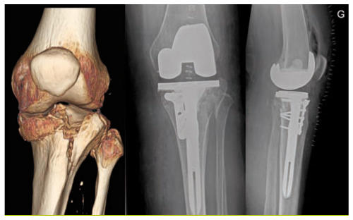 Fractures de la région du genou chez la personne âgée : prise en ...