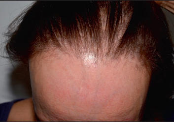 Perte cheveux localisée femme / perte de cheveux que faire floreve