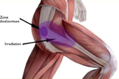 Periarthrite De La Hanche