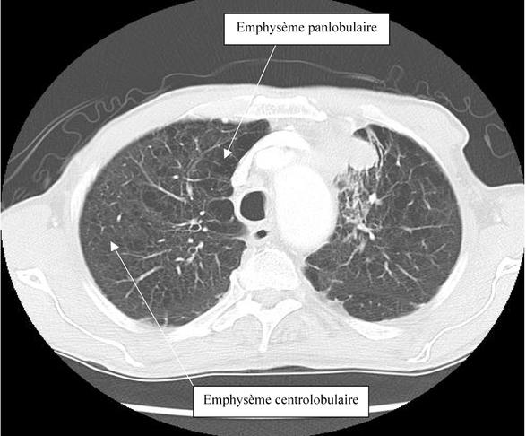 Emphysème pulmonaire : mécanismes et nouvelles perspectives ...