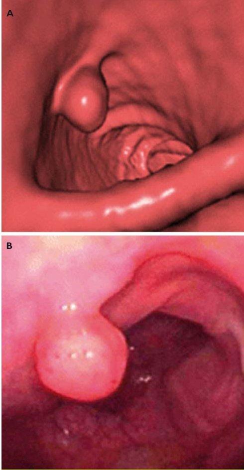 Imagerie scanographique du colon ou coloscopie virtuelle