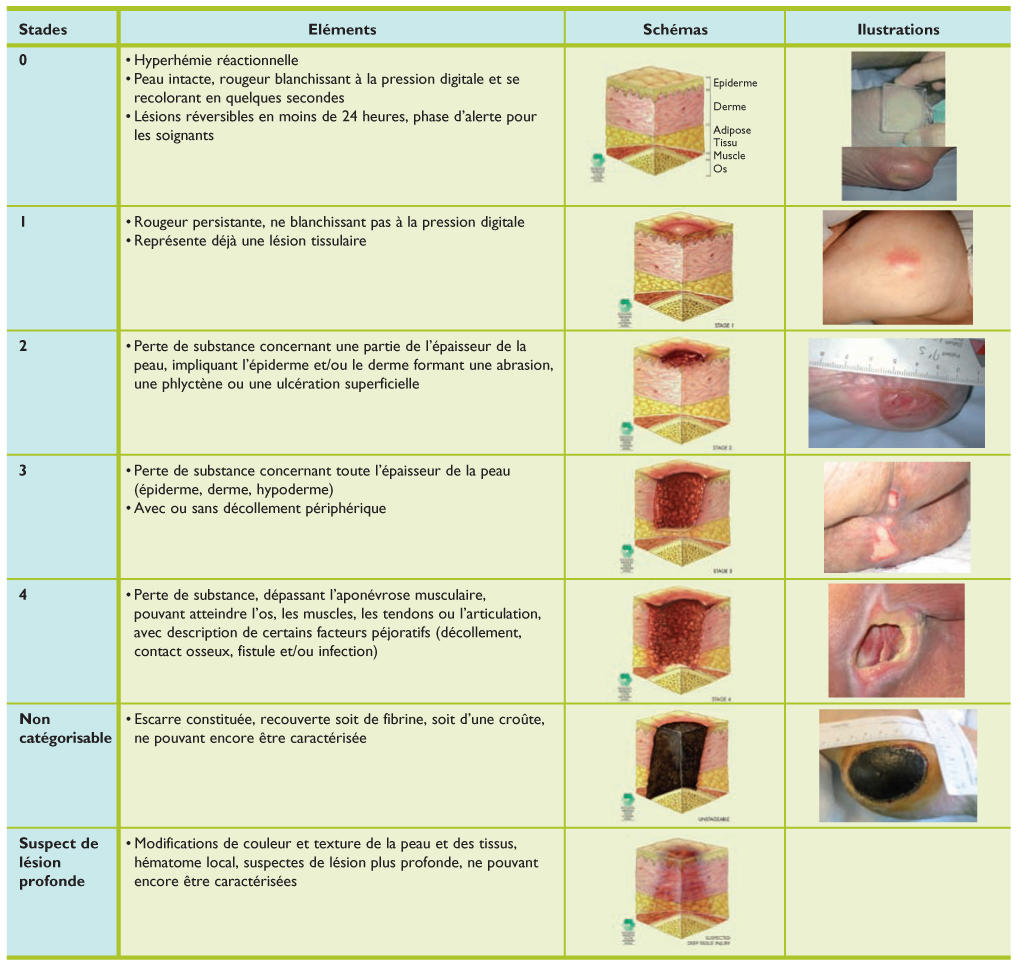 Résumé de cours soins d'escarres  RMS_idPAS_D_ISBN_pu2012-42s_sa10_art10_img003_i1200