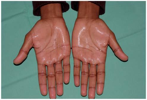 hyperhidrose toxine botulique viermi de capsule