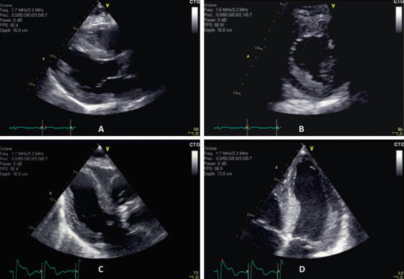Decouverte D Une Hypertrophie Ventriculaire Gauche A L Echocardiographie Adulte Decouverte D Une Hypertrophie Ventriculaire Gauche A L Echocardiographie Adulte