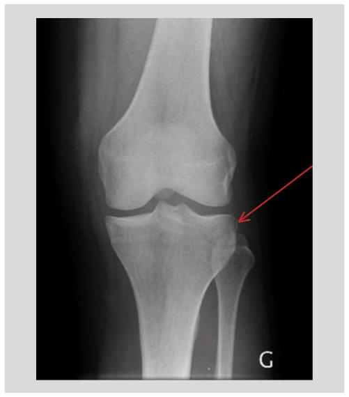 Pièges en orthopédie ambulatoire : le membre inférieur (2)