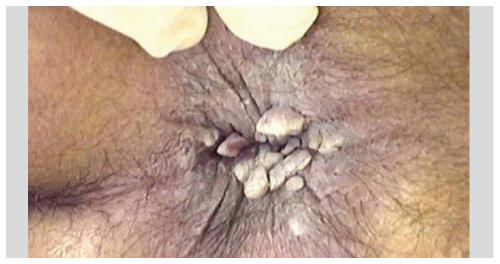 papilloma virus symptome homme