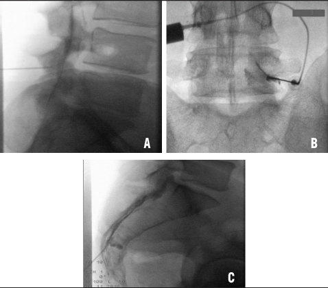 Complications des infiltrations rachidiennes
