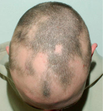 Quand Les Cheveux Se Cassent