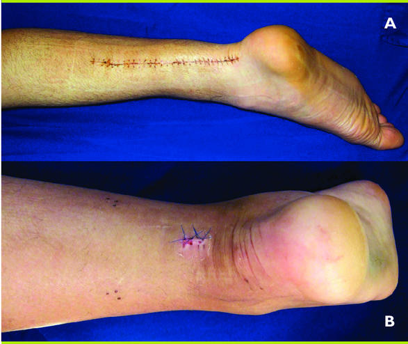 Suture mini-invasive du tendon d'Achille : un concept qui a fait ...