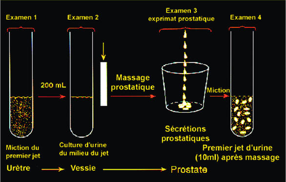 mi a prostatitis mail