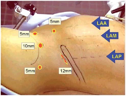 Néphrectomie par laparoscopie : aspects techniques