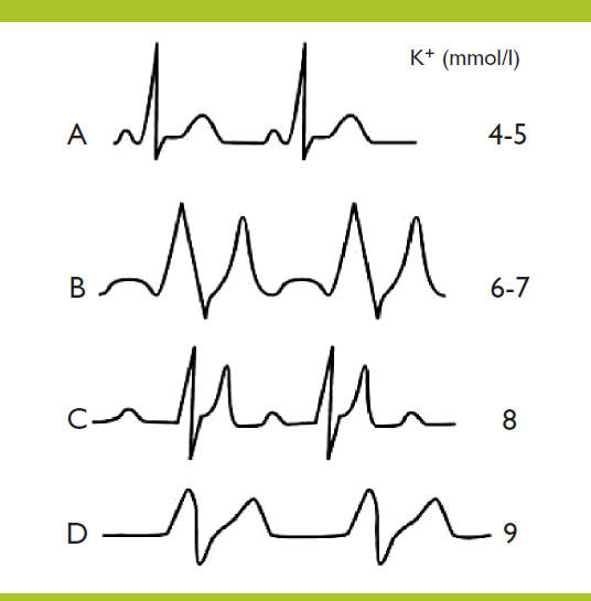 Clinique De L Hyperkaliemie