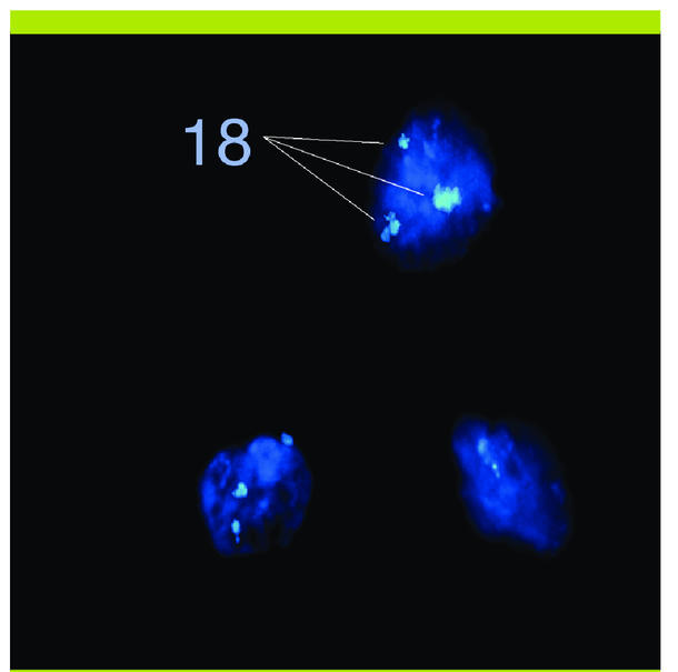 anomalies chromosomiques structurelles