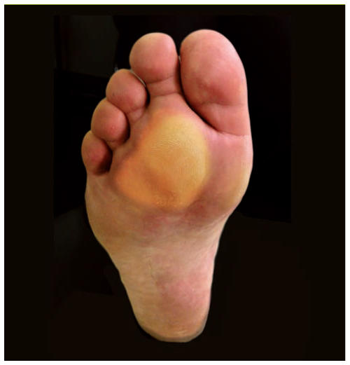 Les métatarsalgies sont des douleurs localisées sous la plante des pieds,  causées par une surcharge ou une inflammation des tissus, aggravées par des  chaussures inappropriées ou un excès de poids - chirurgie