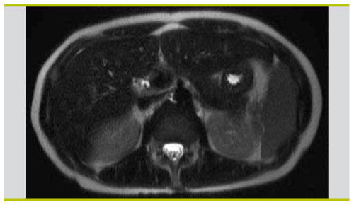 Infection Grave A Cytomegalovirus Cmv Pas Seulement Chez Les Patients Immunosupprimes