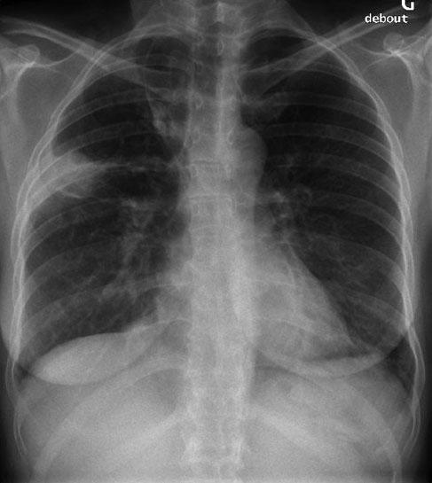 Abcès pulmonaires : évolution dans la prise en charge ?