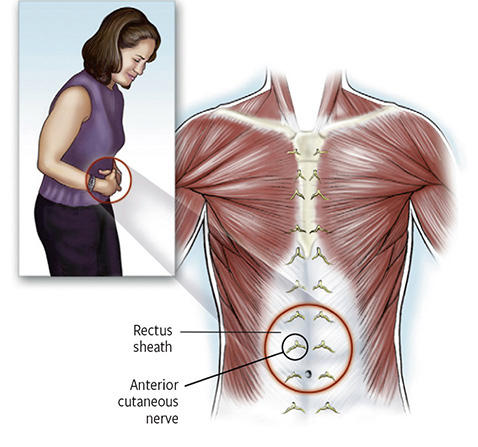 Douleurs Abdominales D Origine Parietale Syndrome De Compressionde Nerf Cutane Anterieur