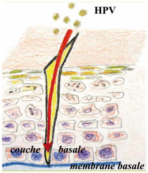 Hpv outbreak causes - HPV vaccine: Help your kids prevent cancer paraziti ma doare- n