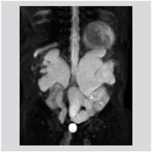 Evolution De L Imagerie Abdominale Chez L Enfant Developpement Des Applications En Irm