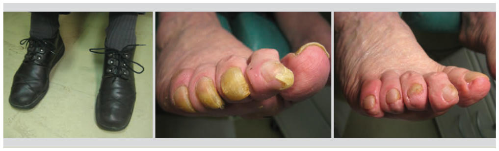 Lesions Non Traumatiques Du Pied Cors Et Ongles Impact Socio Economique D Un Probleme Meconnu