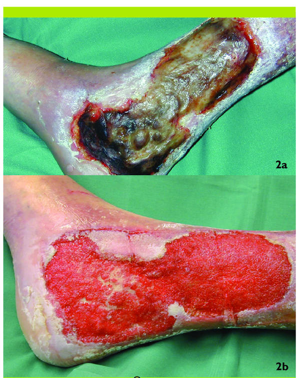 ulcère de stase veineuse vs ulcère artériel