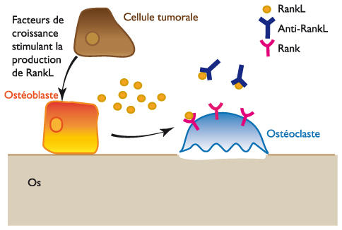 cancer prostate complications osseuses