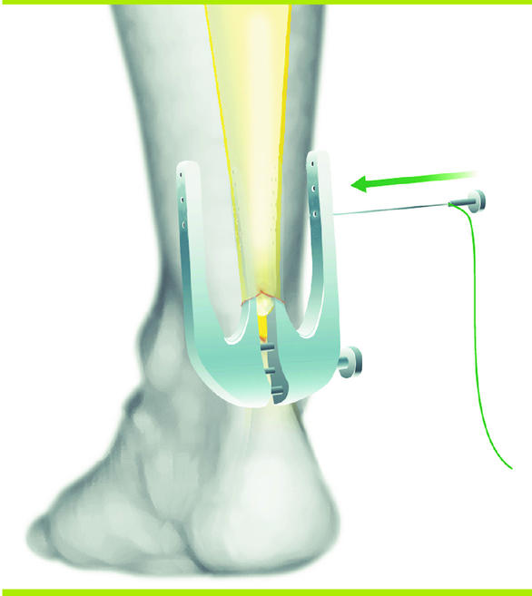 Suture mini-invasive du tendon d'Achille : un concept qui a fait ...