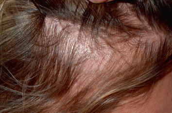 Quand Les Cheveux Se Cassent