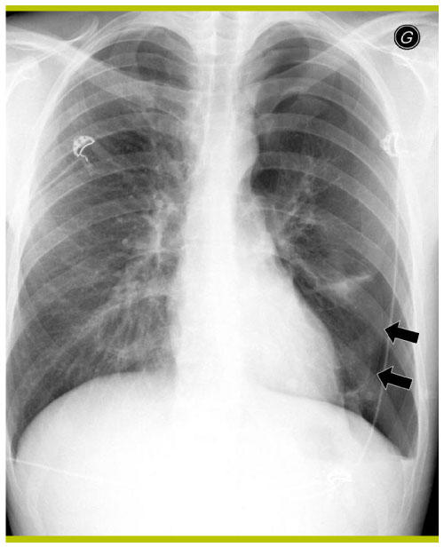 pneumothorax radiographie pulmonaire