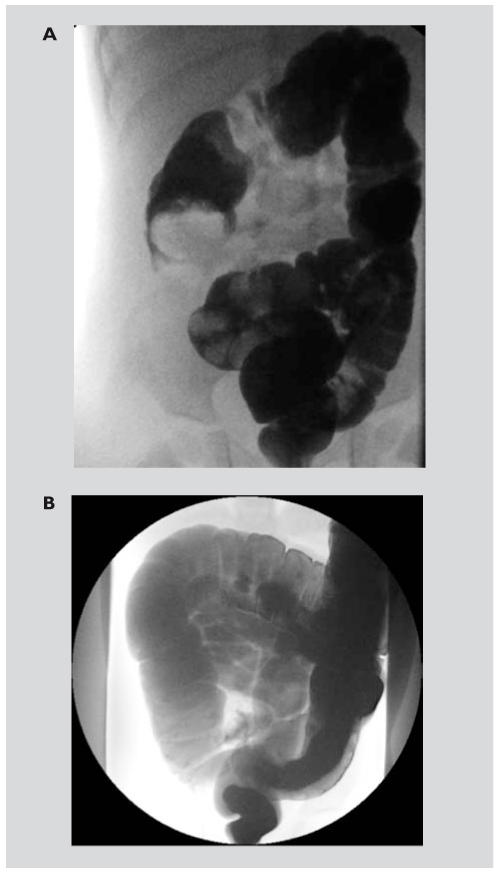 Invagination Intestinale Chez L Enfant Une Triade Vraiment Classique