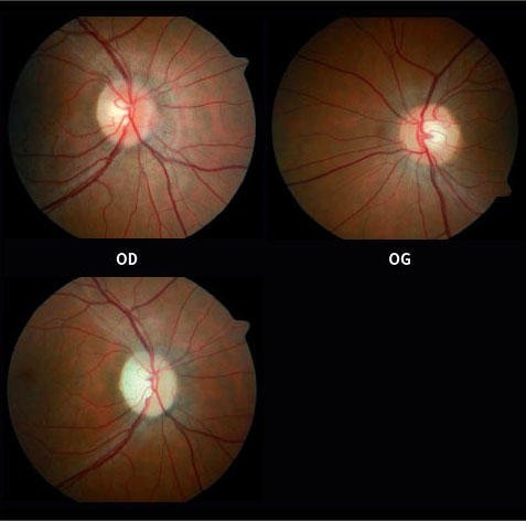 Trastorno explique Adepto Névrite du nerf optique : diagnostic, traitement et implications cliniques