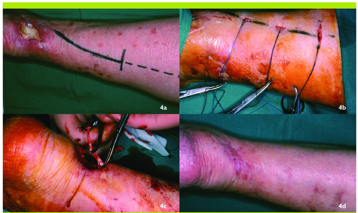 ulcère de stase veineuse vs ulcère artériel