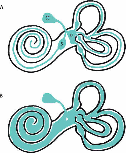 maladie de meniere hydrops endolymphatique et irm