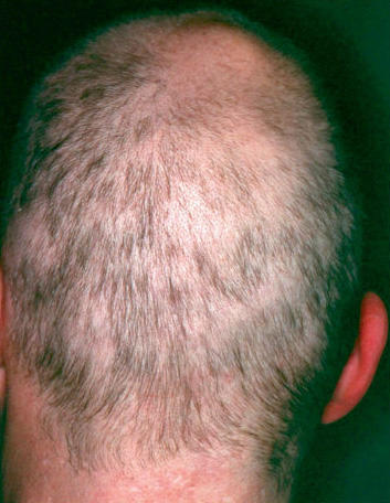 Quand Les Cheveux Se Cassent