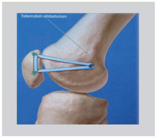 Figure 4. Reconstruction anatomique du ligament patello-fémoral médial (MPF...
