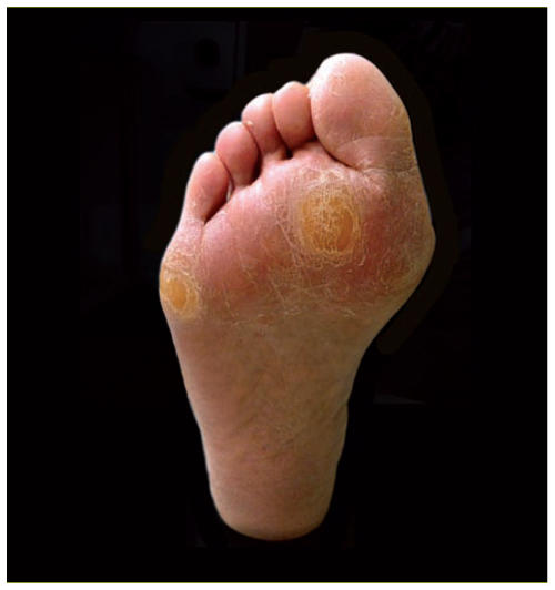 Metatarsalgies Diagnostic Et Prise En Charge