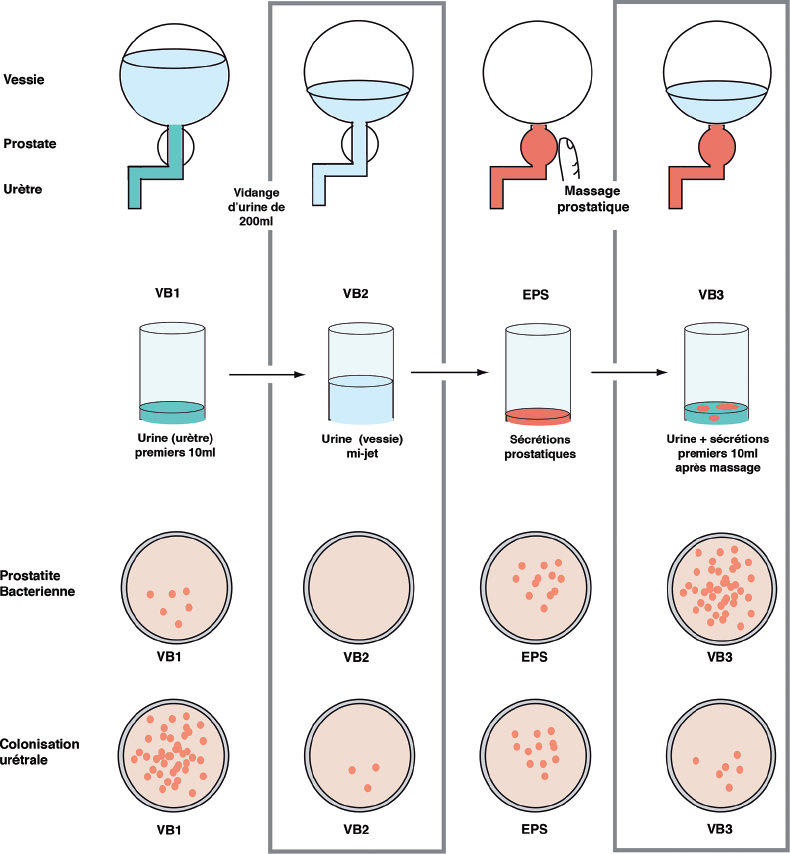 prostatitis és klebsiella