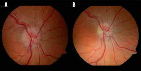 Névrite du nerf optique : diagnostic, traitement et implications ...