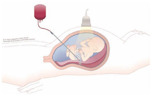 Thérapie fœtale : la chirurgie avant la naissance ?