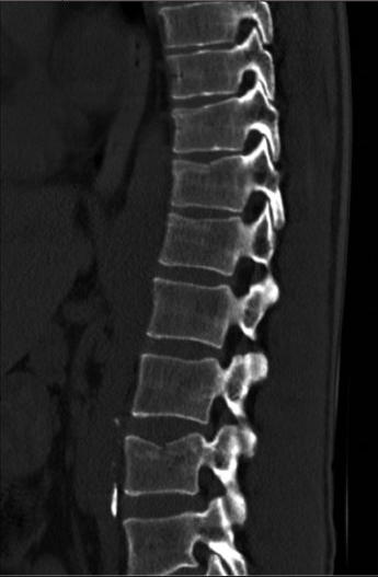 Complications des infiltrations rachidiennes