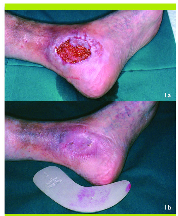 ulcère de stase veineuse vs ulcère artériel