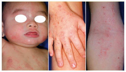 PHYSIONORM™ Baby  Dermatite atopique & colique nourrisson
